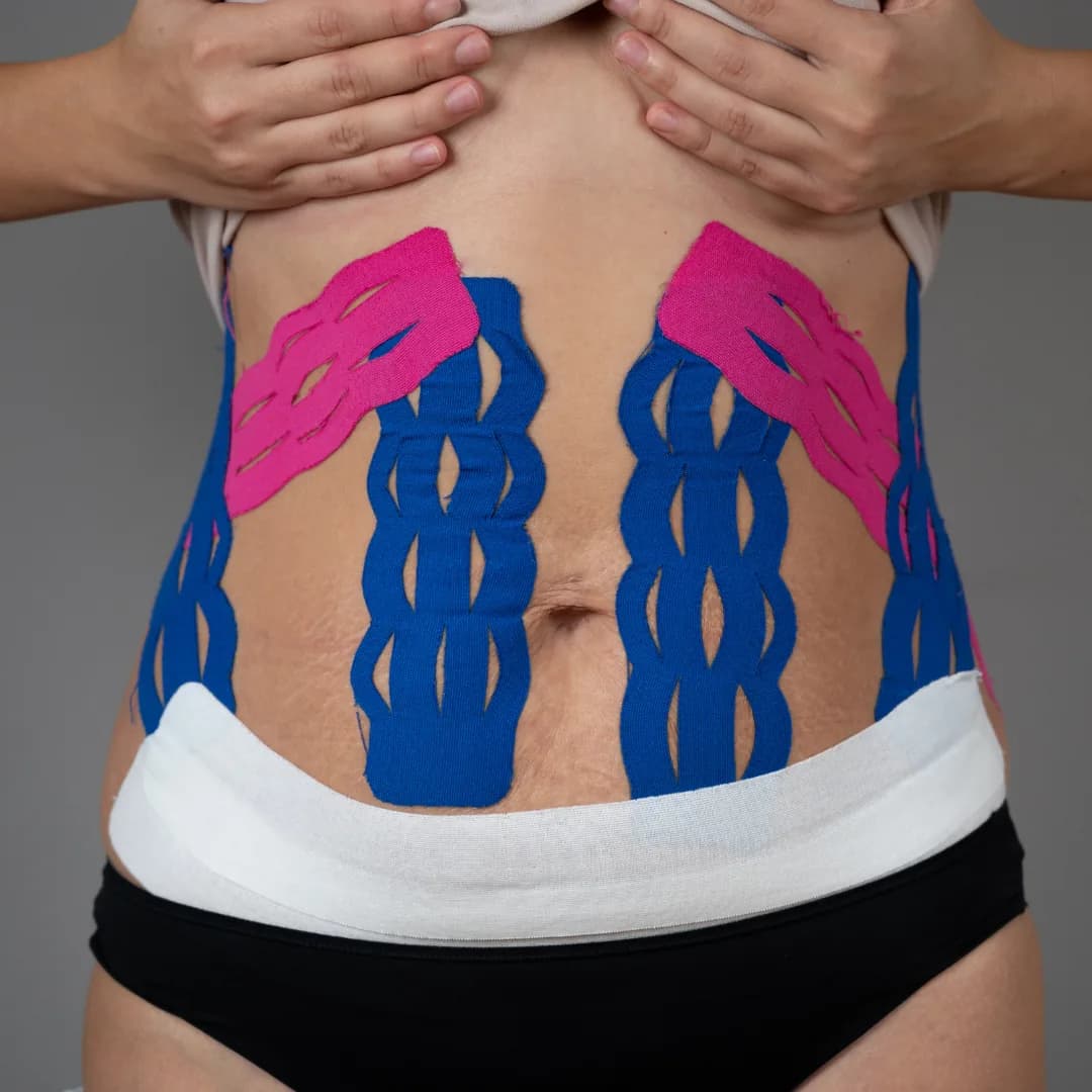 A postnatal stomach with kinesiology support tape applied either side of the midline